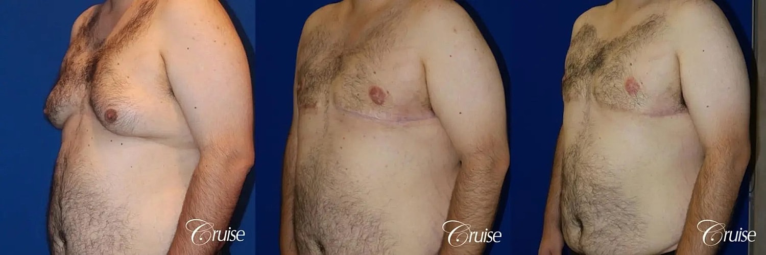 Gynecomastia Before & After