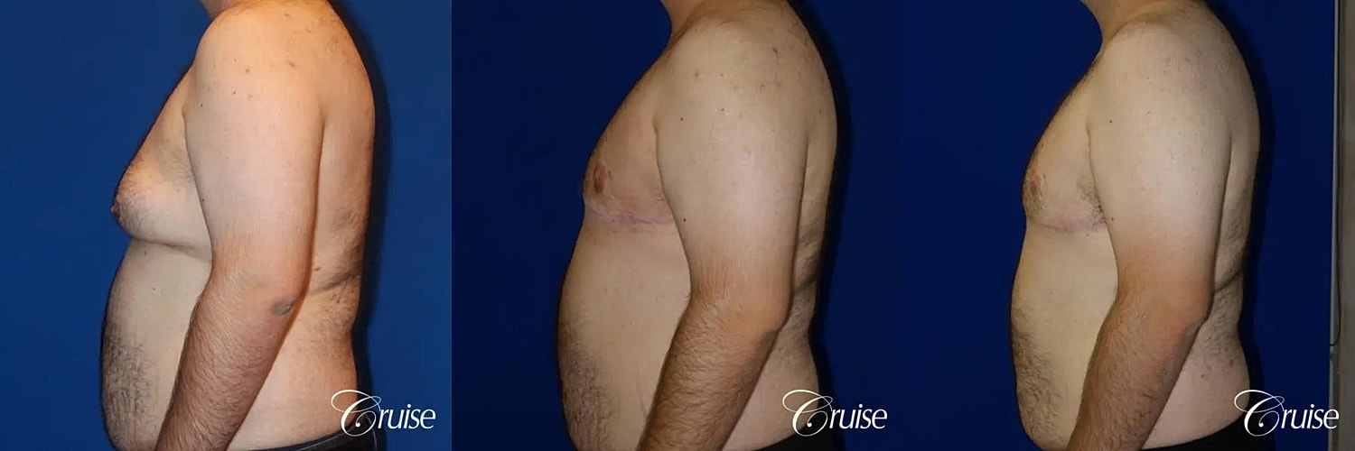 Gynecomastia Before & After