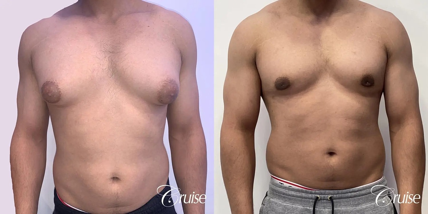 Gynecomastia Before & After