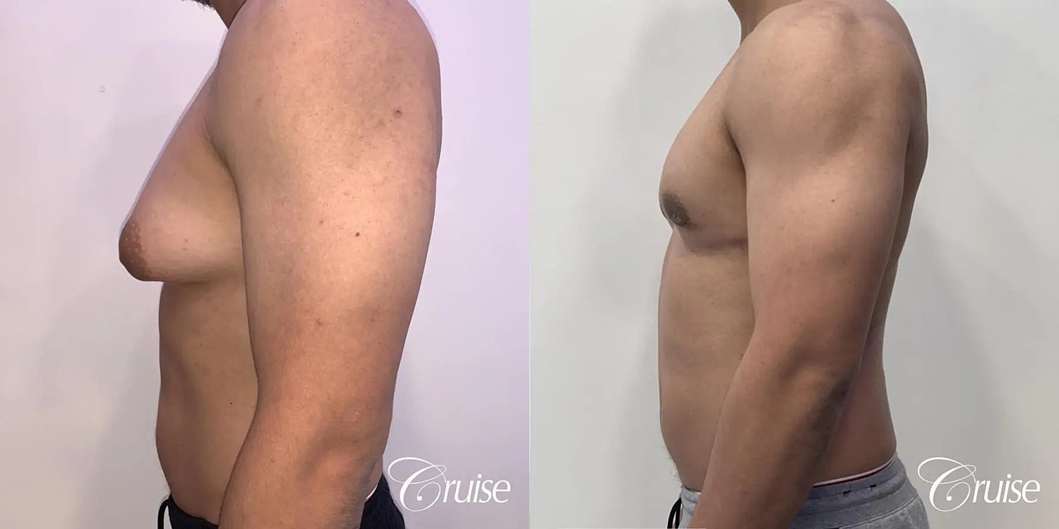 Gynecomastia Before & After
