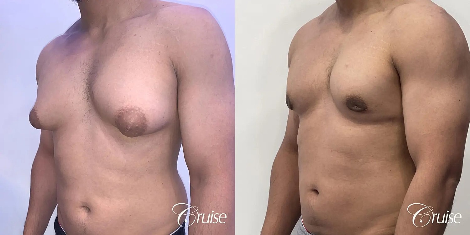 Gynecomastia Before & After