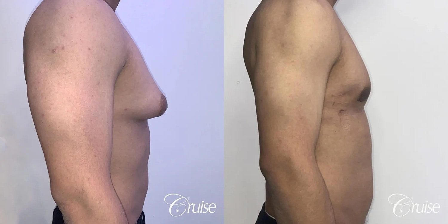 Gynecomastia Before & After