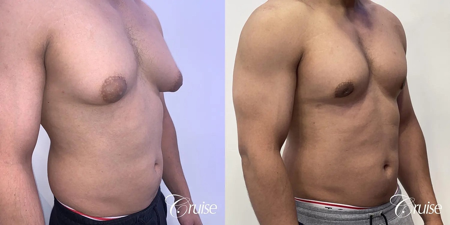Gynecomastia Before & After