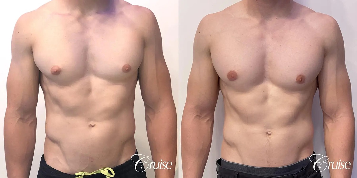 Gynecomastia Before & After