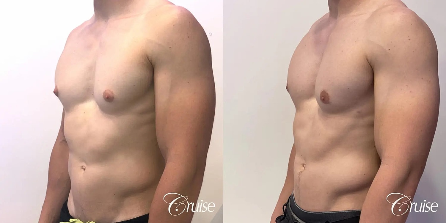 Gynecomastia Before & After