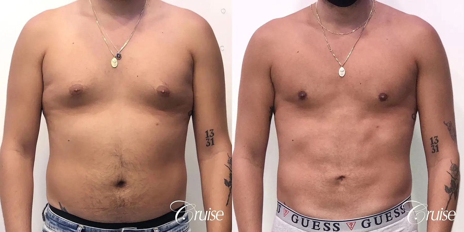 Gynecomastia Before & After