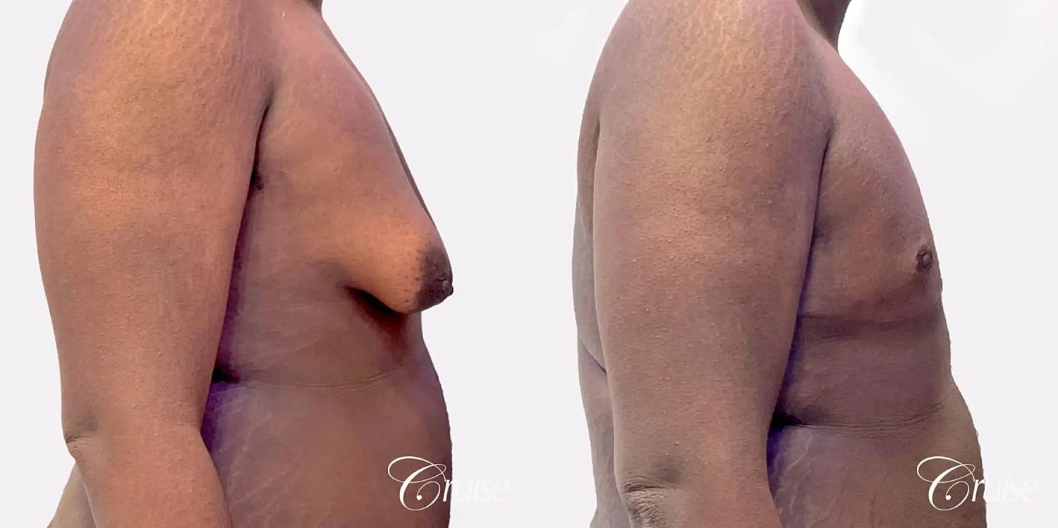 Gynecomastia Before & After