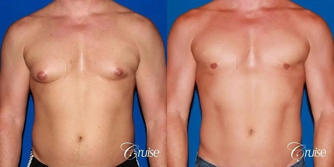 Gynecomastia Before & After