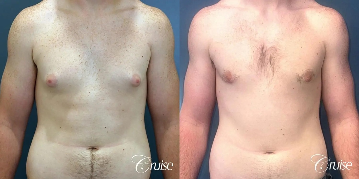 Gynecomastia Before & After