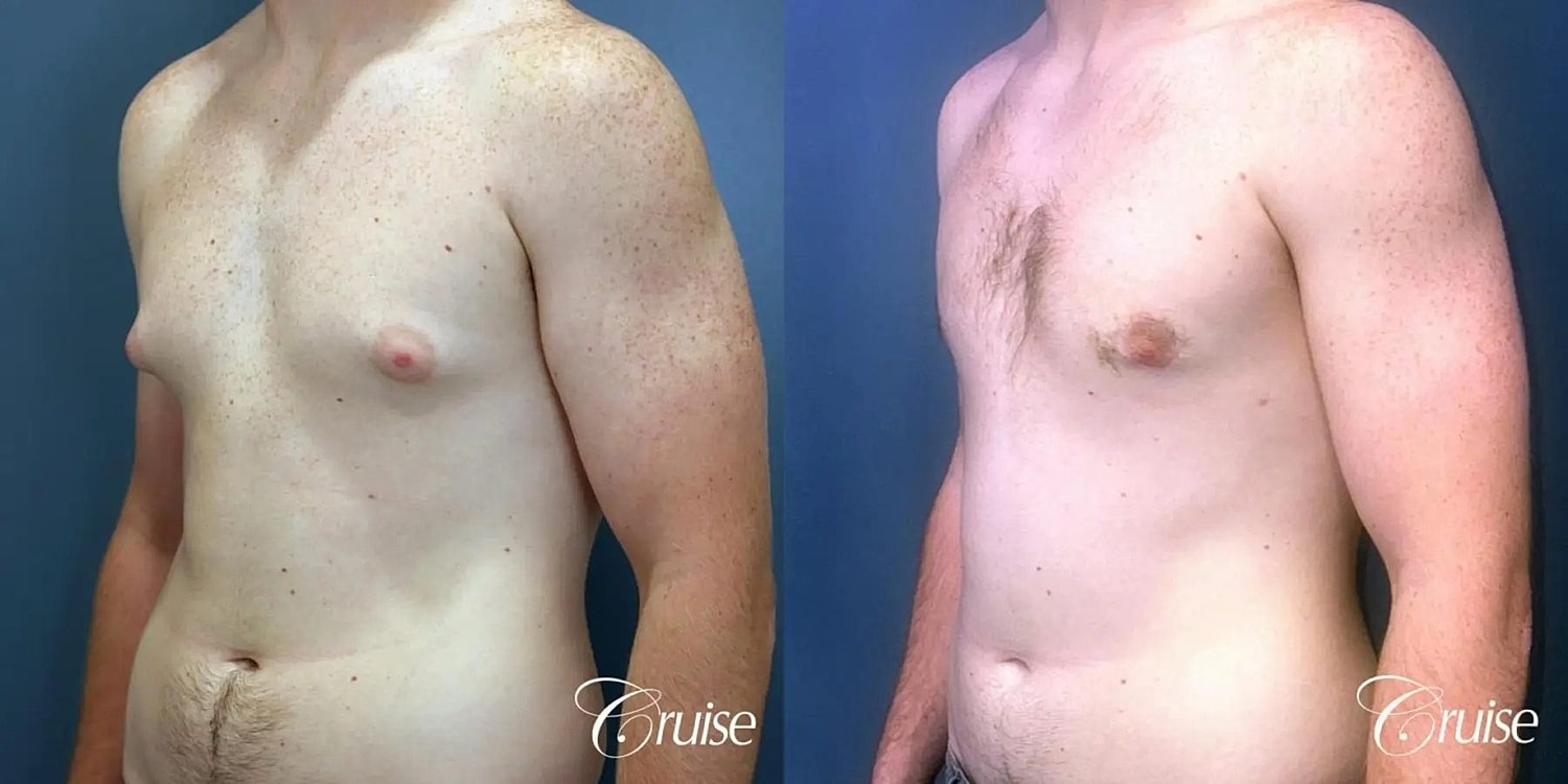 Gynecomastia Before & After