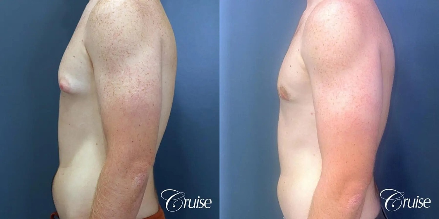 Gynecomastia Before & After