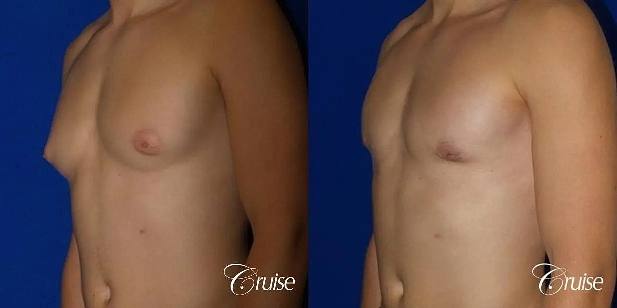 Gynecomastia Before & After