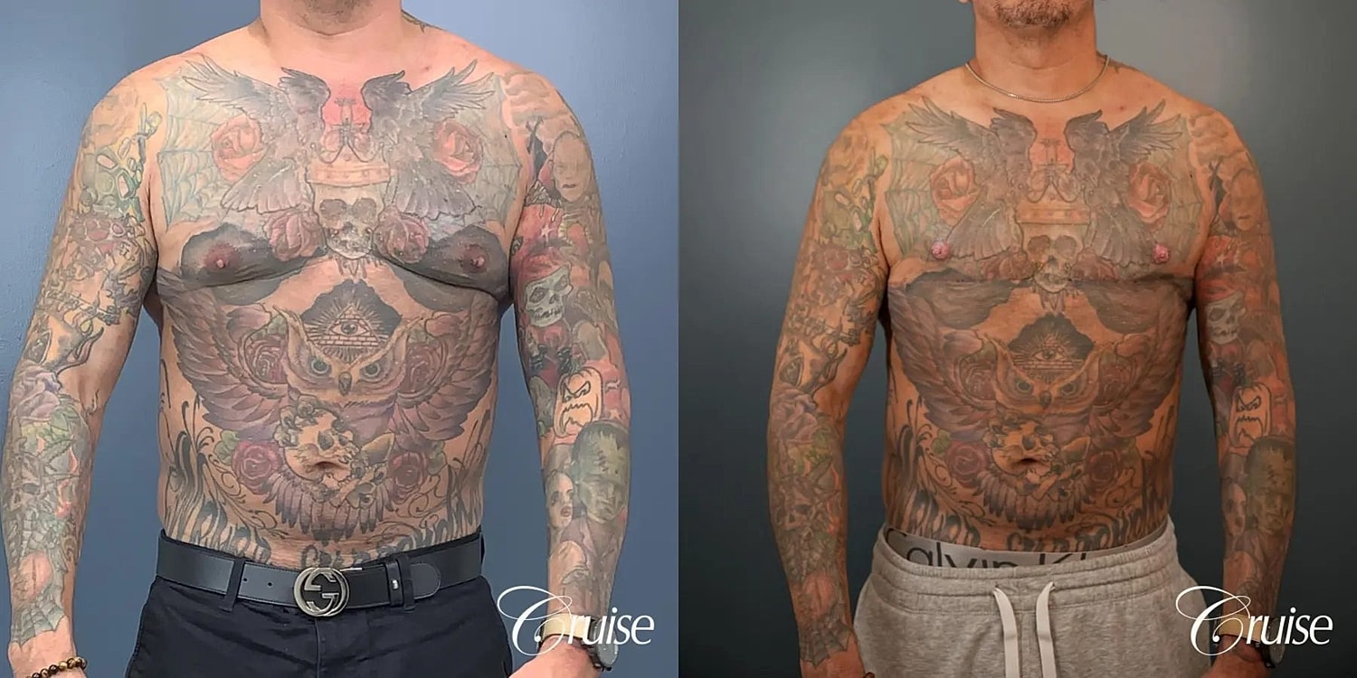 Gynecomastia Before & After