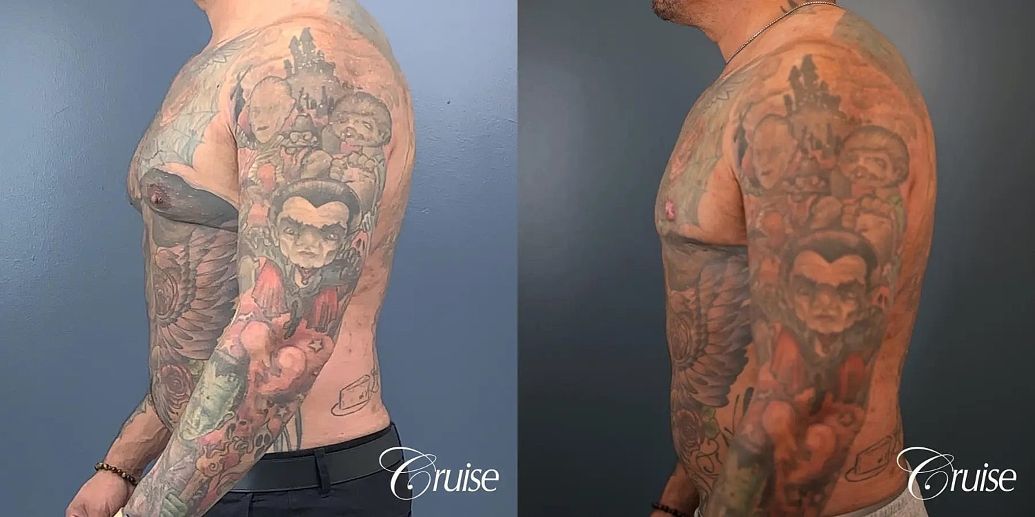 Gynecomastia Before & After