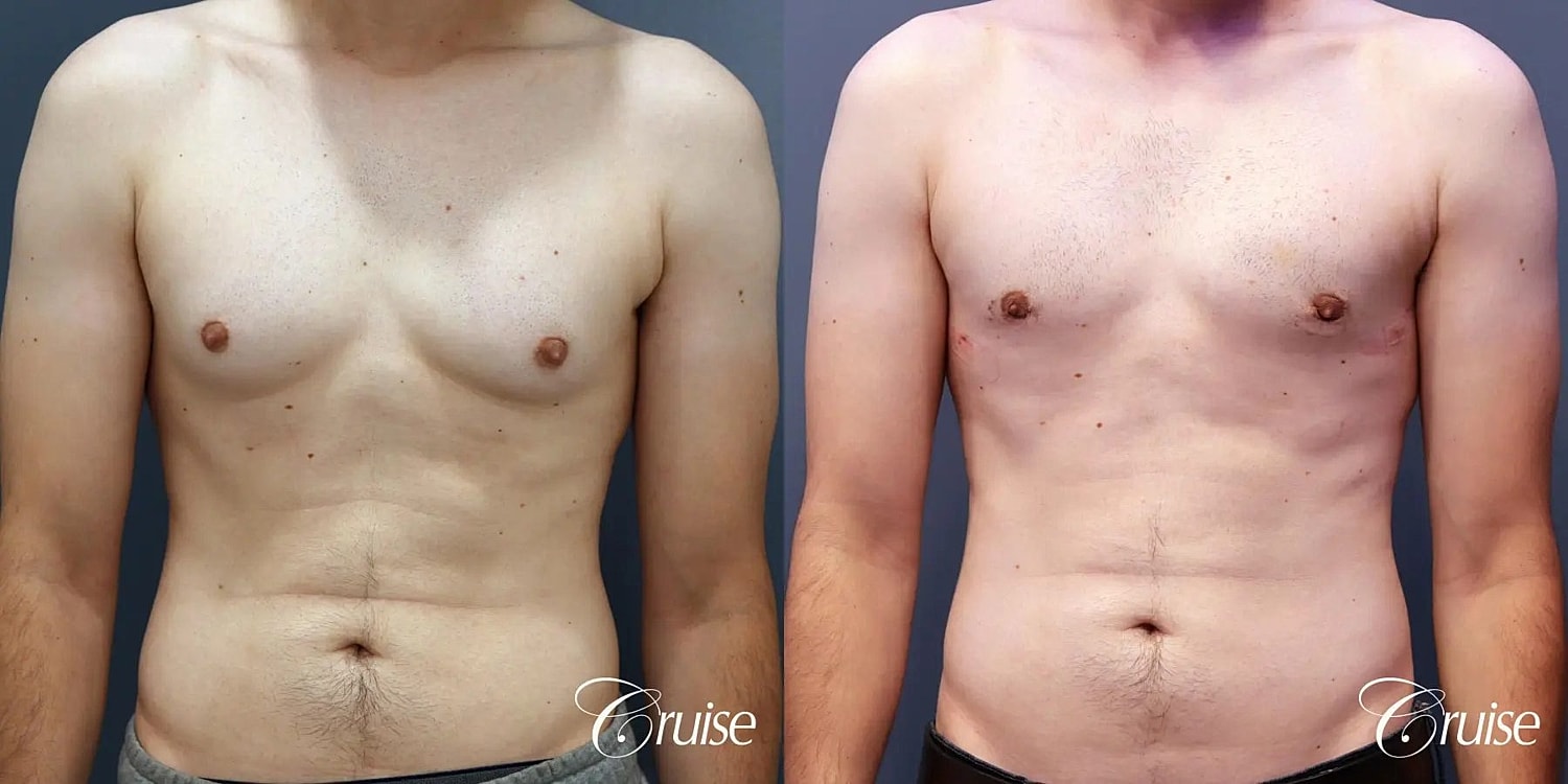 Gynecomastia Before & After