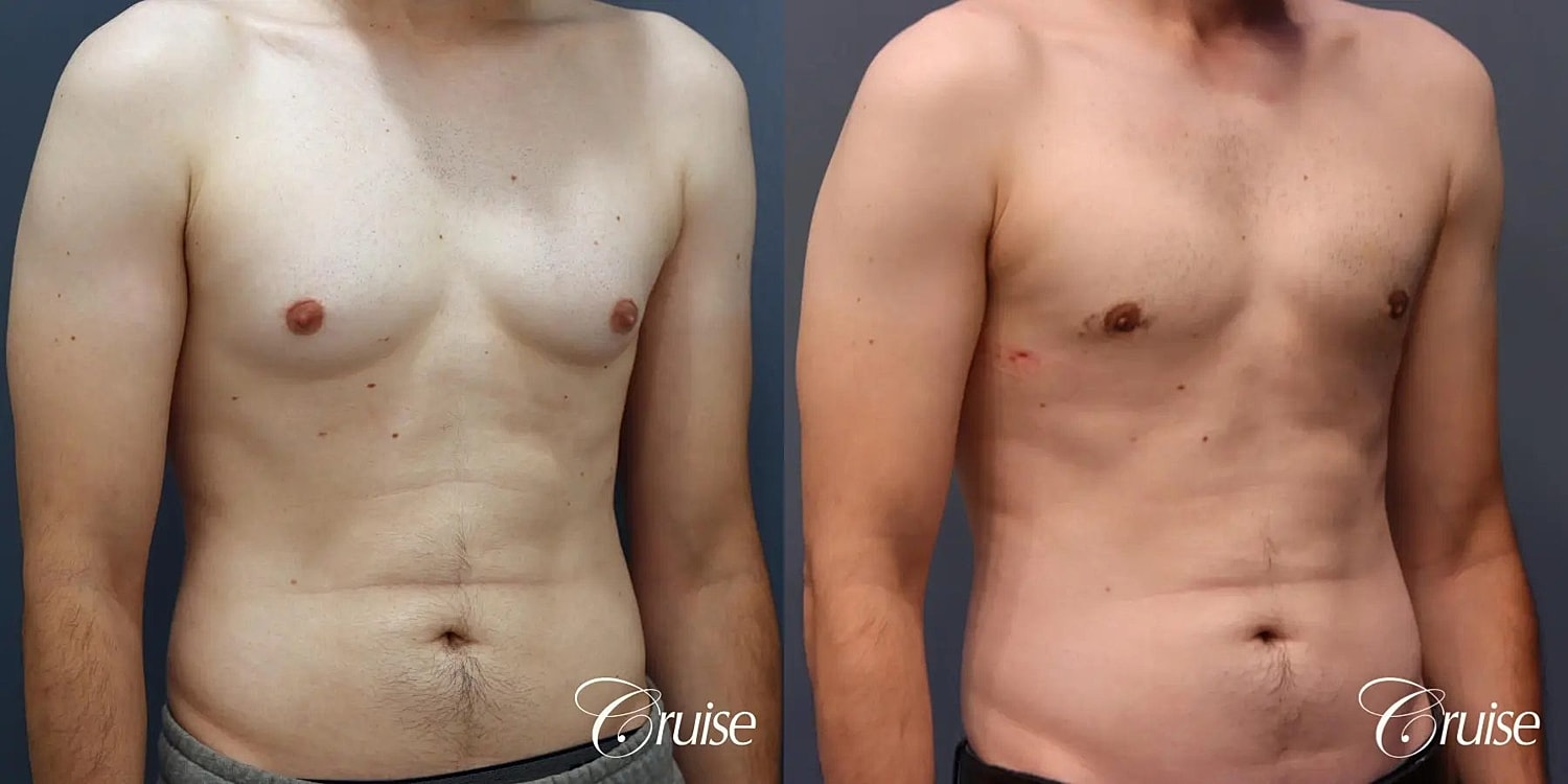 Gynecomastia Before & After