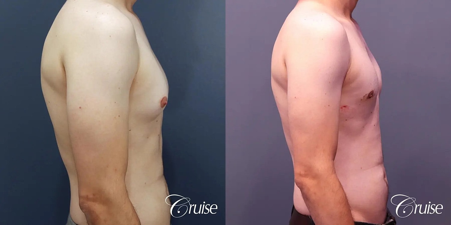 Gynecomastia Before & After