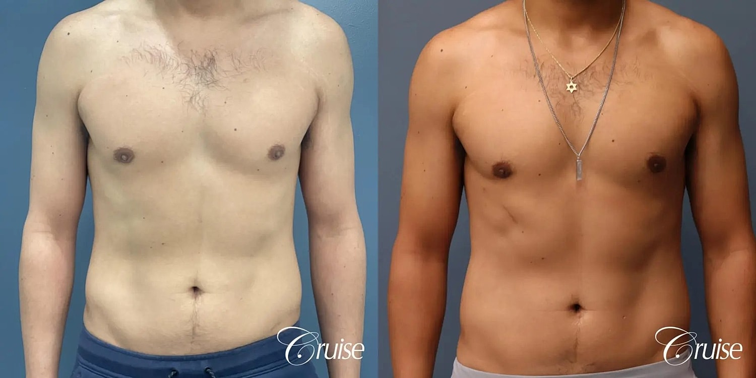 Gynecomastia Before & After