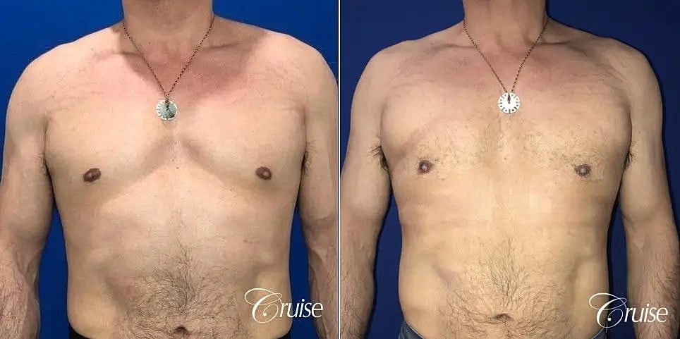 Gynecomastia Before & After