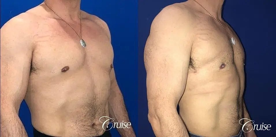 Gynecomastia Before & After