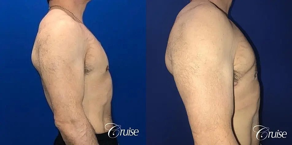 Gynecomastia Before & After