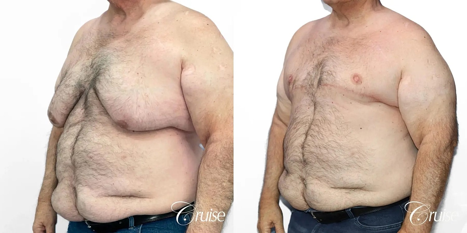 Gynecomastia Before & After