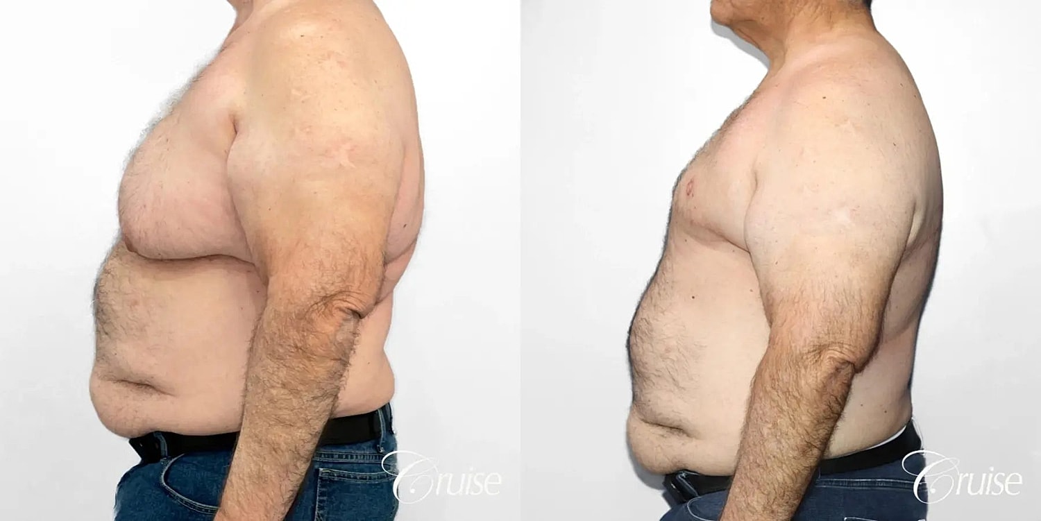 Gynecomastia Before & After