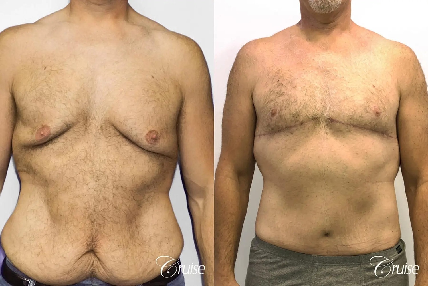 Gynecomastia Before & After