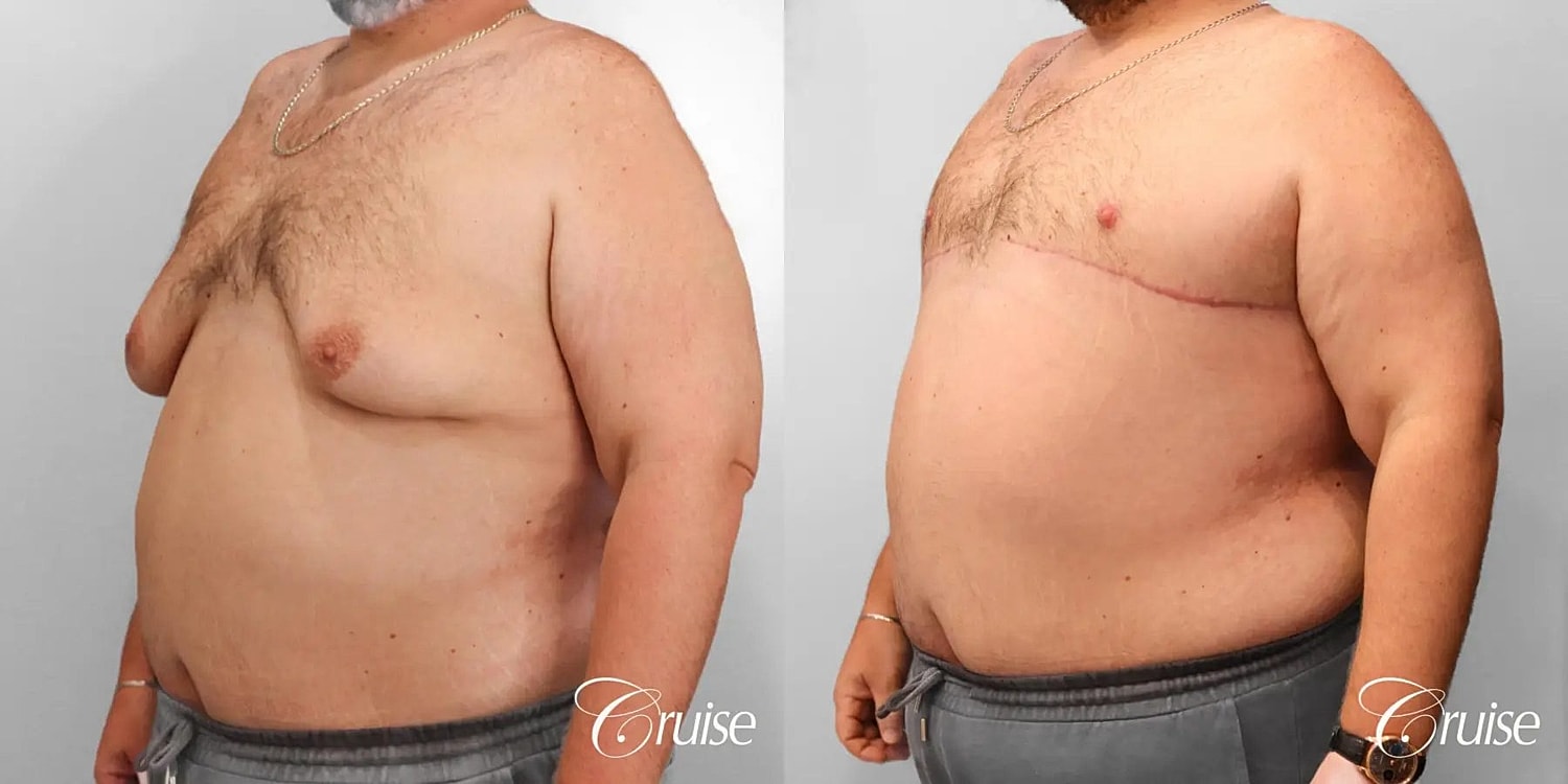 Gynecomastia Before & After