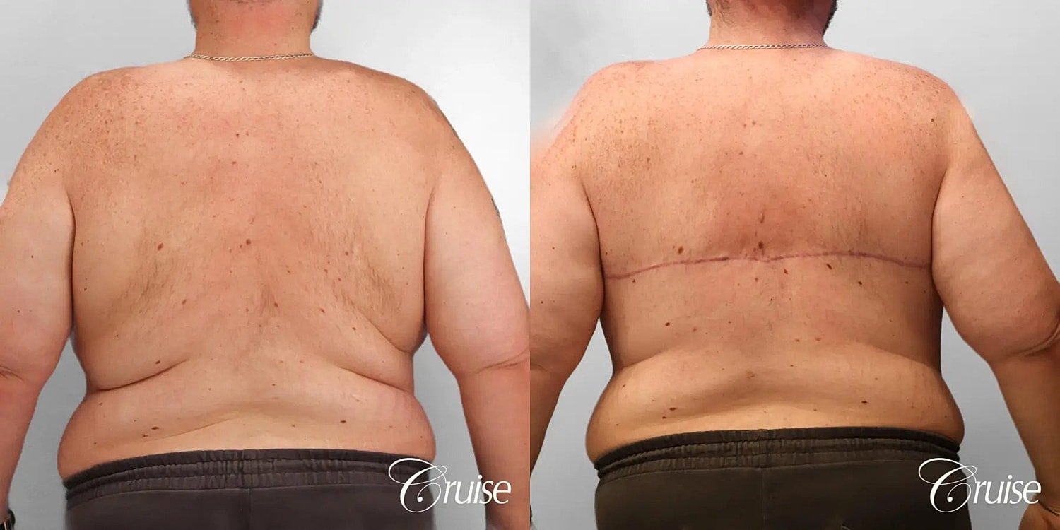 Gynecomastia Before & After