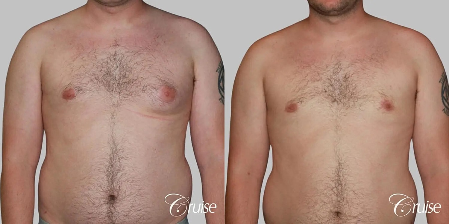 Gynecomastia Before & After