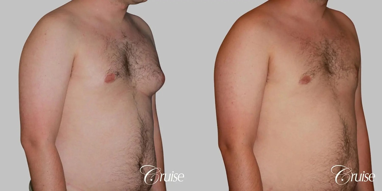 Gynecomastia Before & After