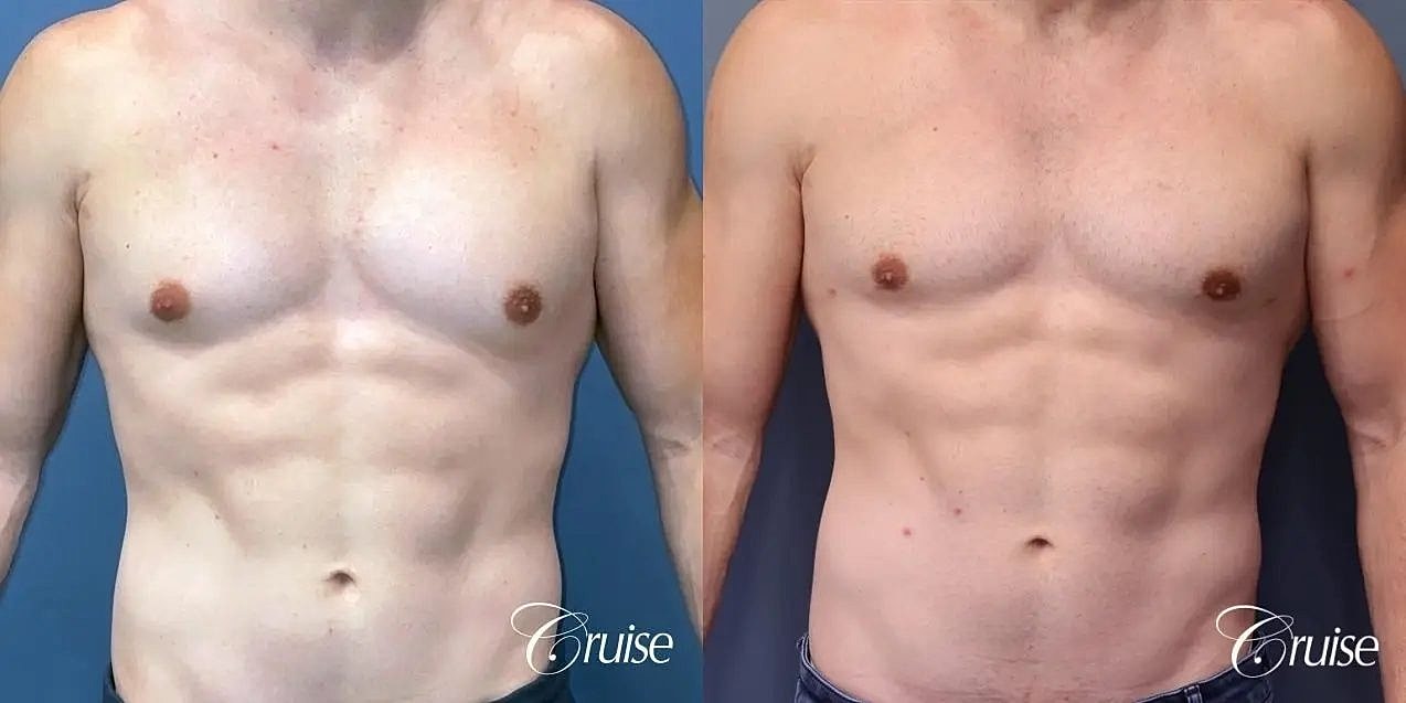 Gynecomastia Before & After