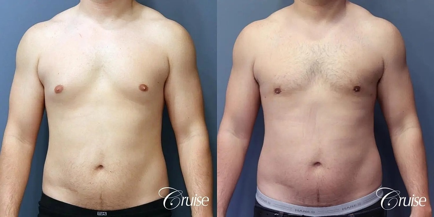 Gynecomastia Before & After