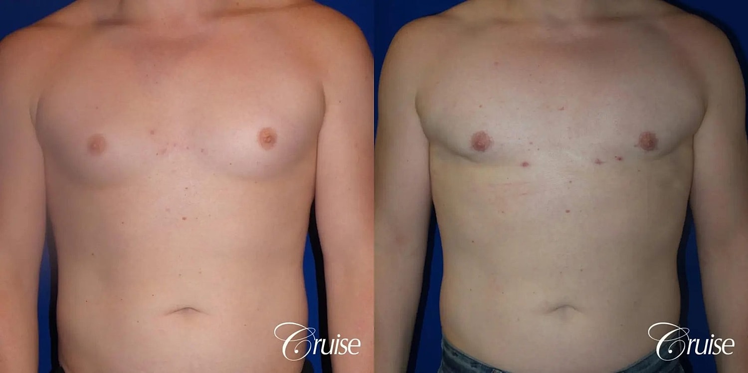 Gynecomastia Before & After