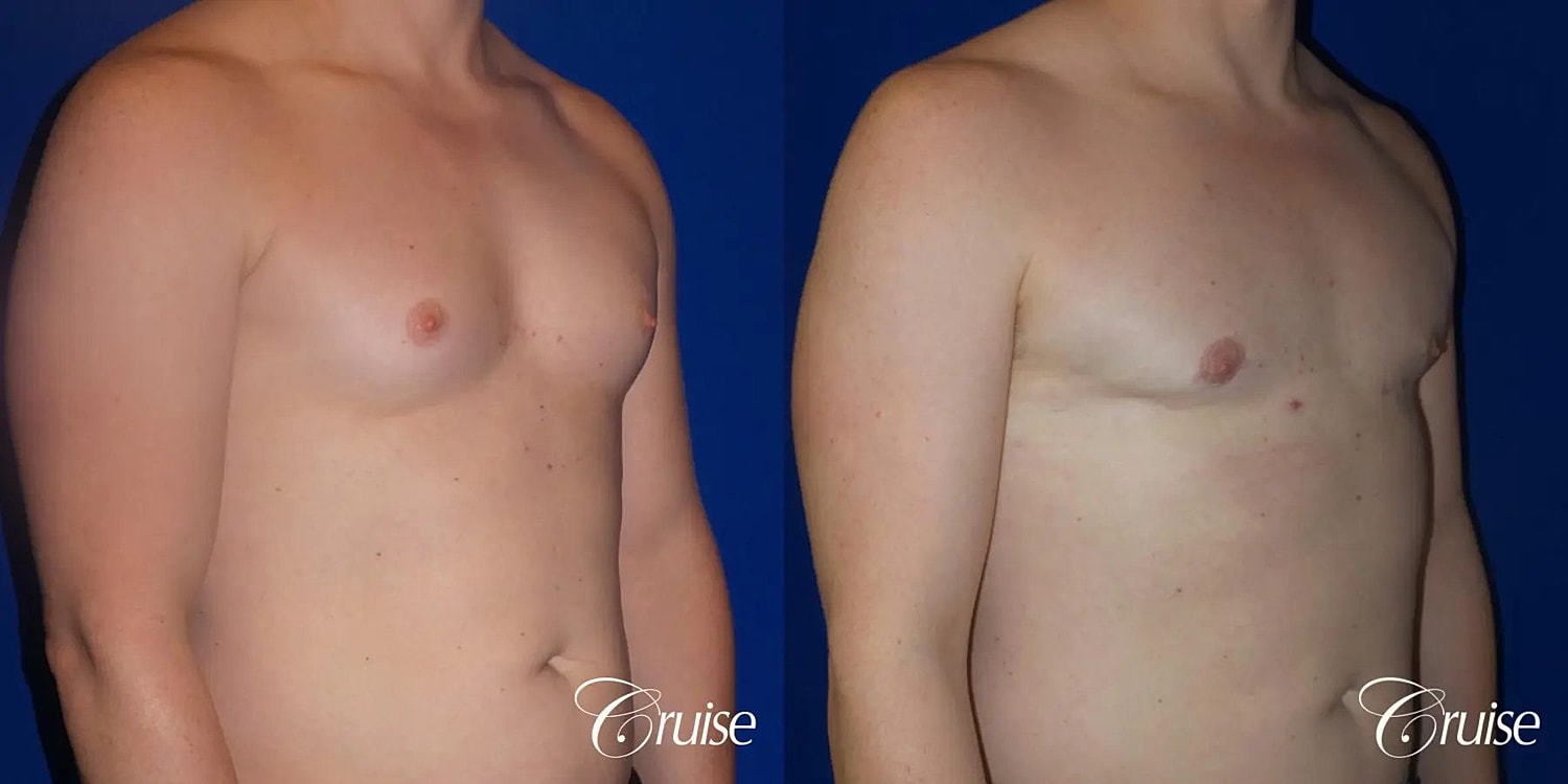 Gynecomastia Before & After