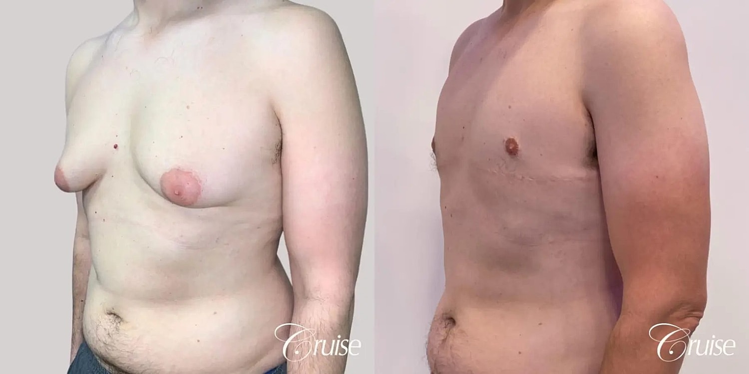 Gynecomastia Before & After