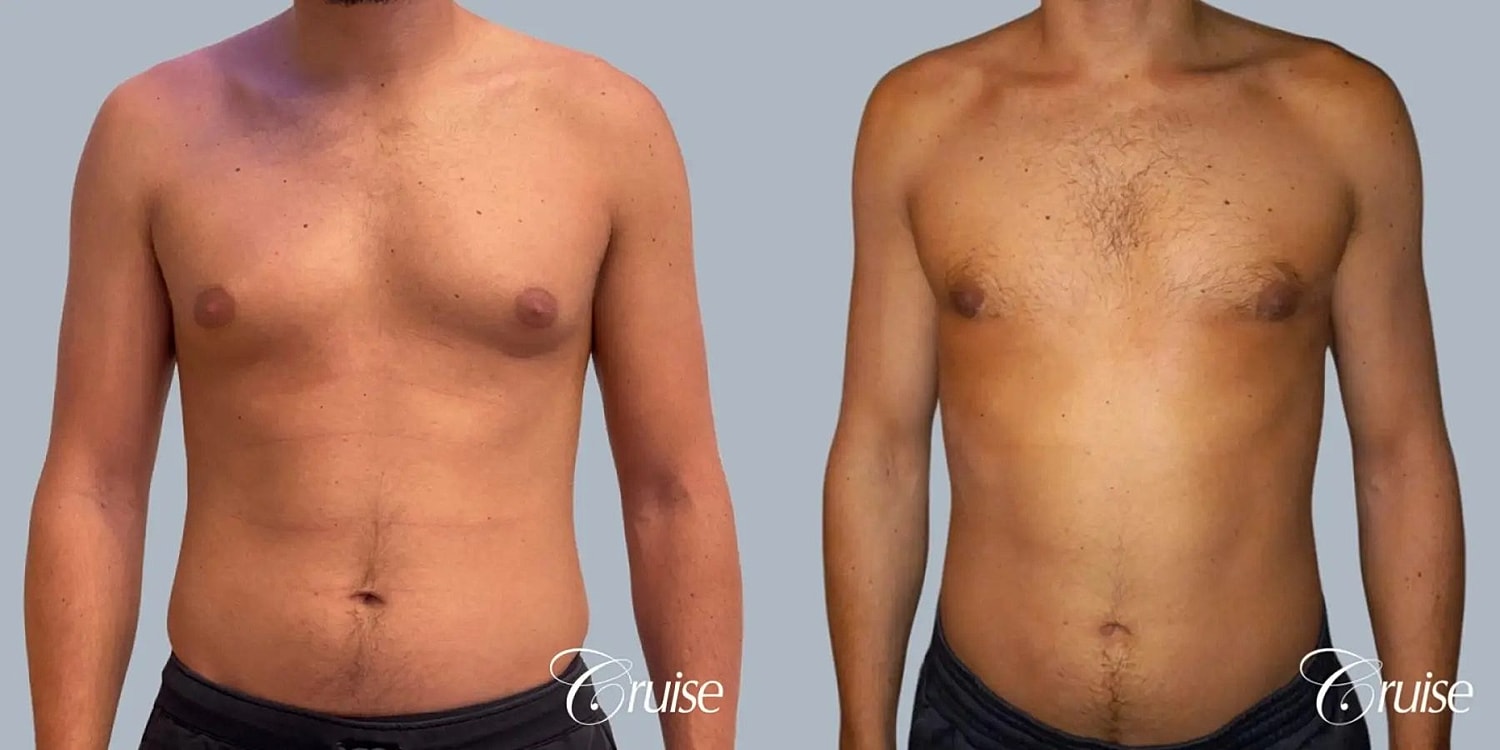 Gynecomastia Before & After