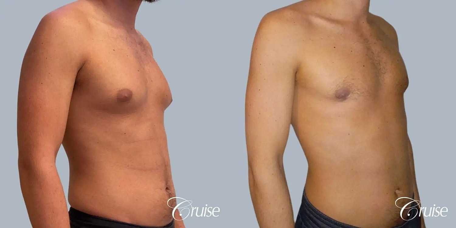 Gynecomastia Before & After