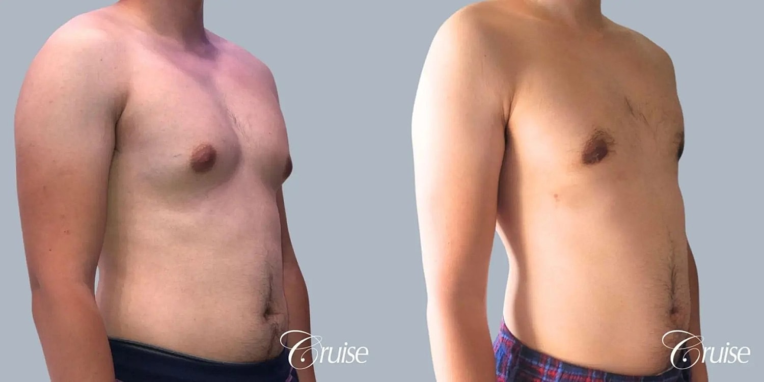 Gynecomastia Before & After