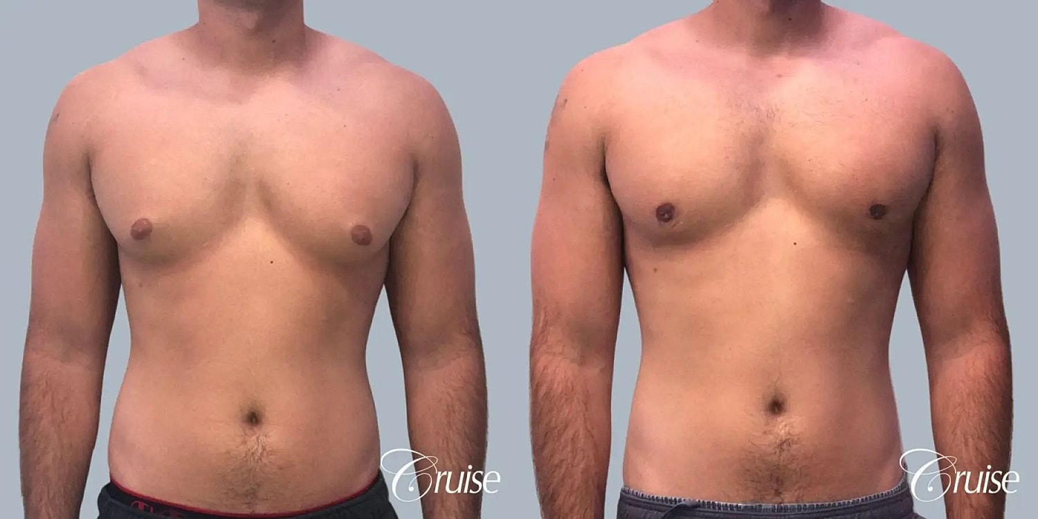Gynecomastia Before & After