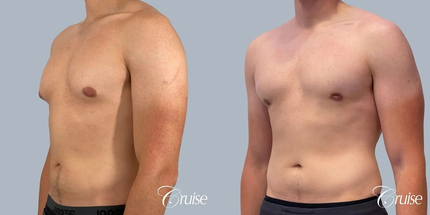 Gynecomastia Before & After
