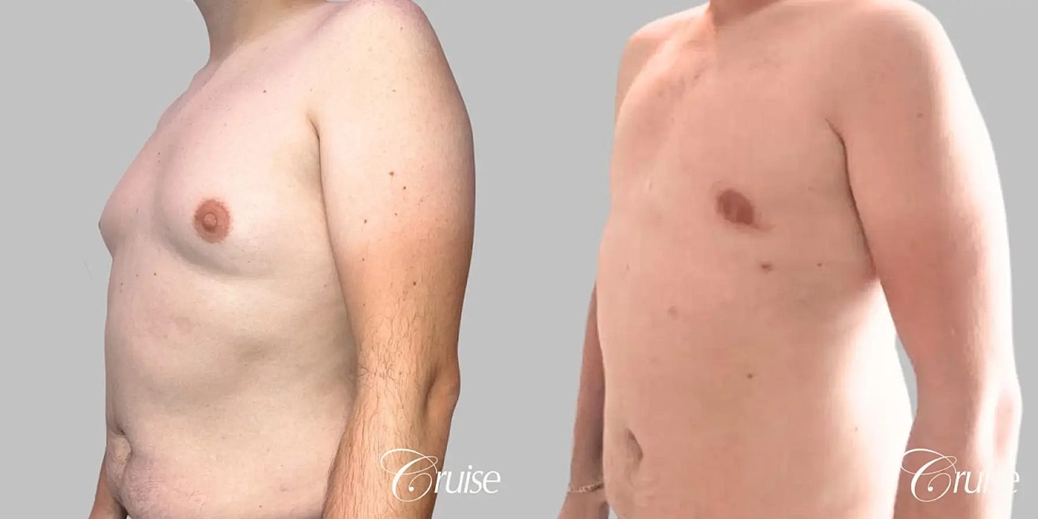 Gynecomastia Before & After