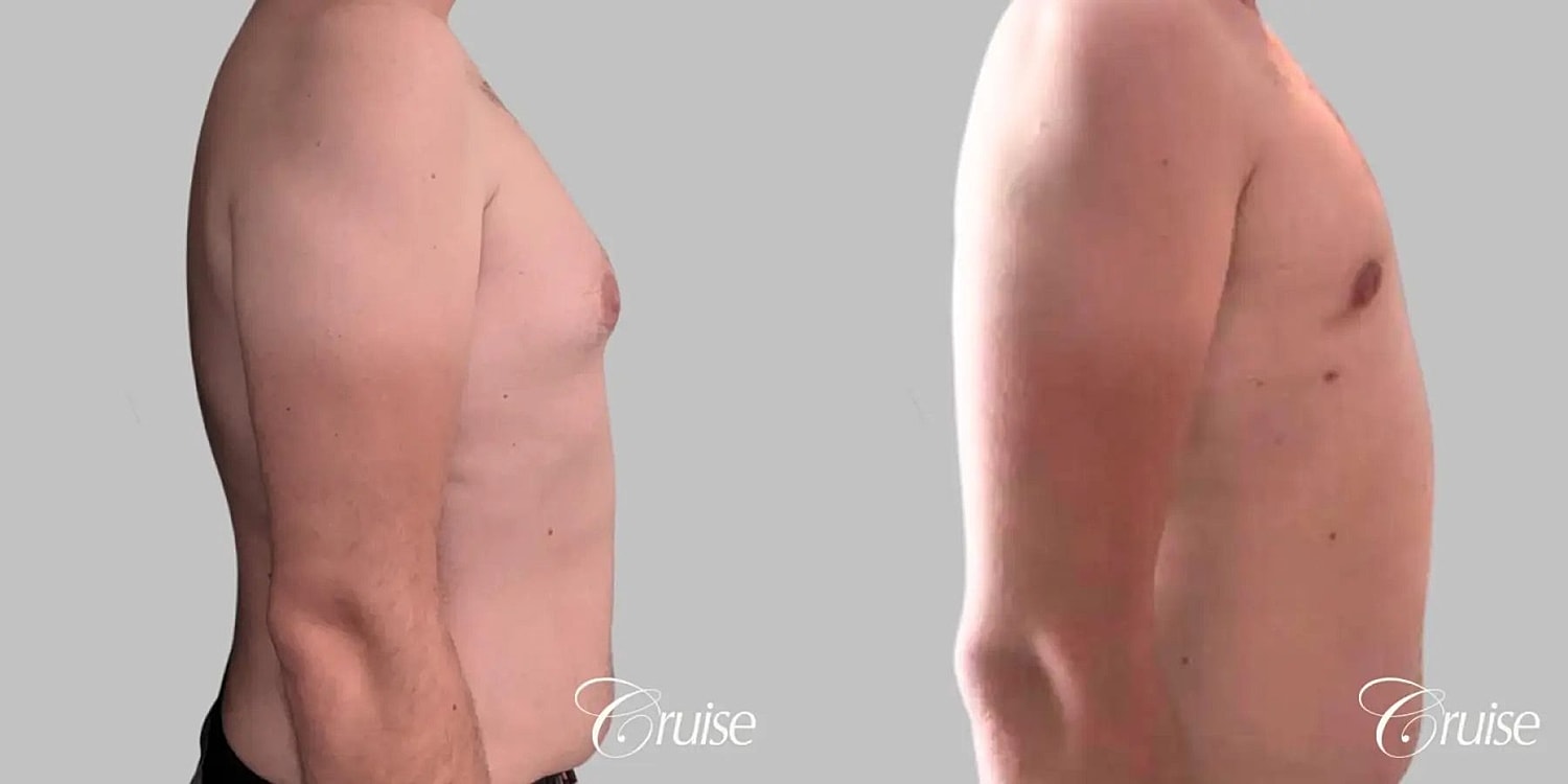 Gynecomastia Before & After