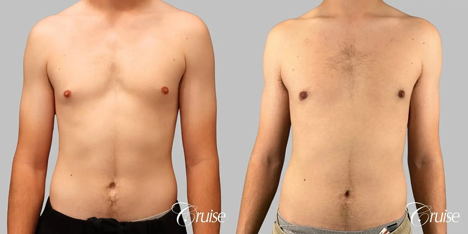 Gynecomastia Before & After