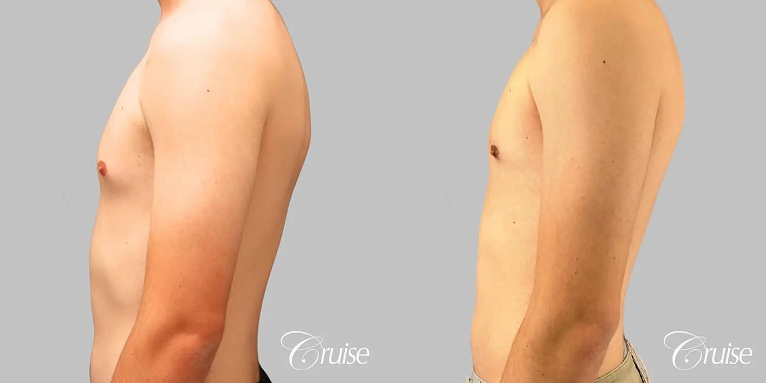 Gynecomastia Before & After