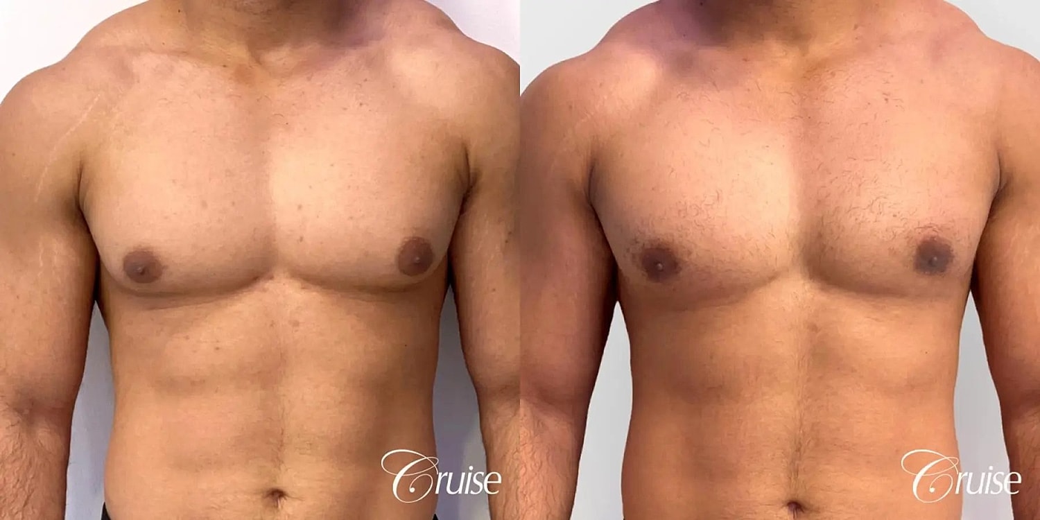 Gynecomastia Before & After