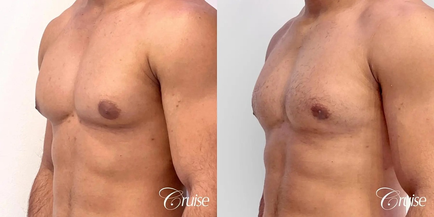Gynecomastia Before & After