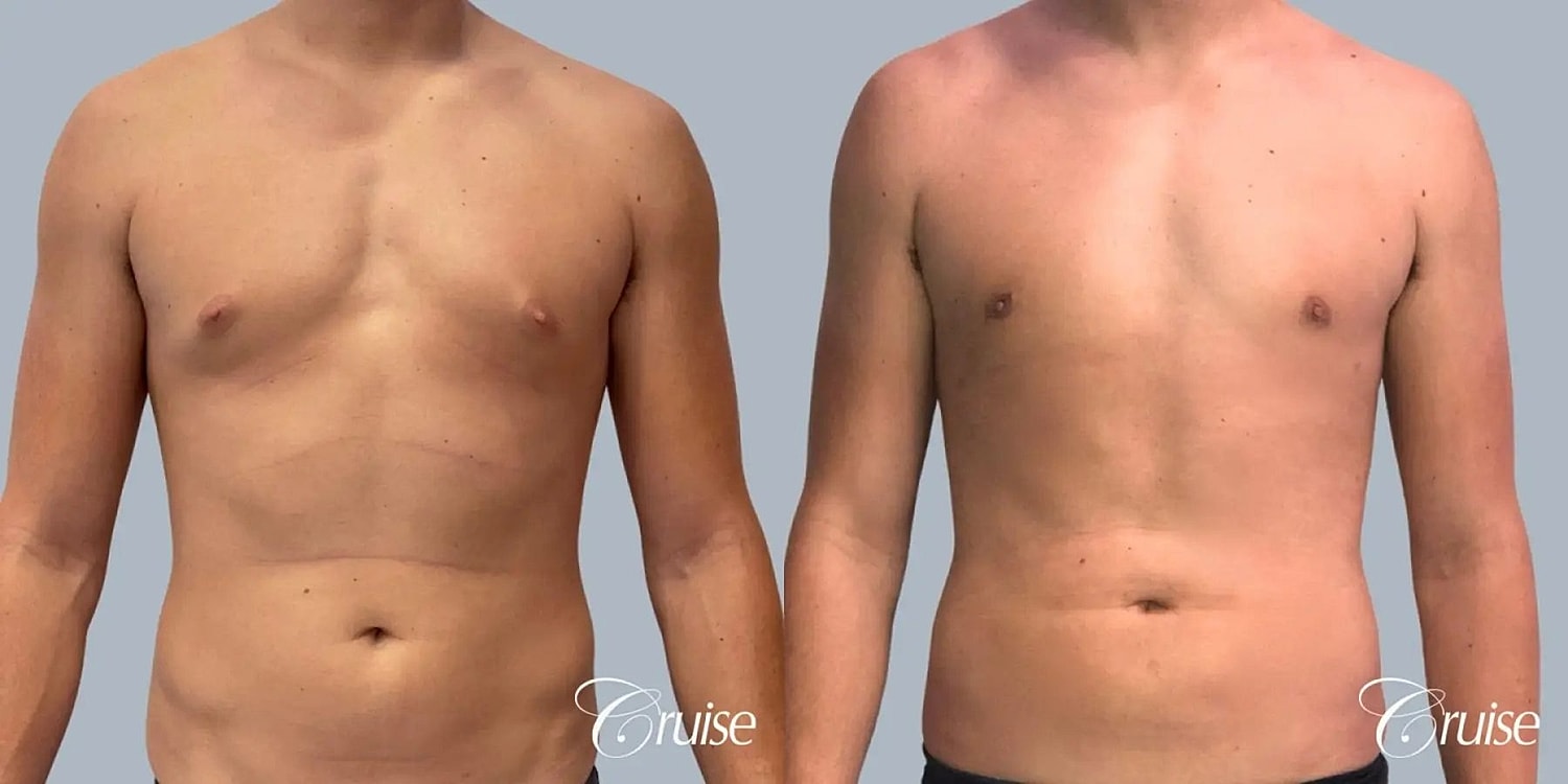 Gynecomastia Before & After