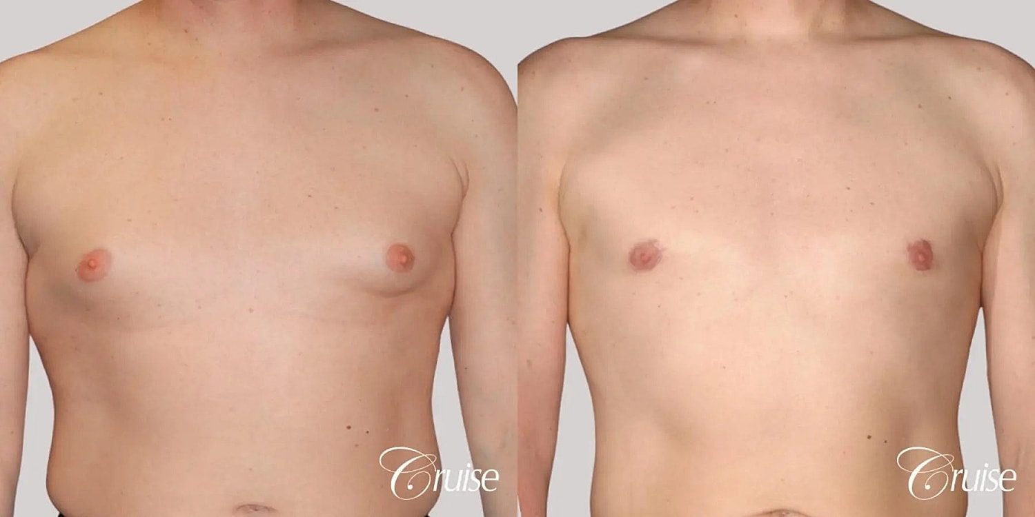 Gynecomastia Before & After
